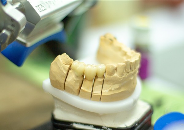 Full mouth rehabilitation